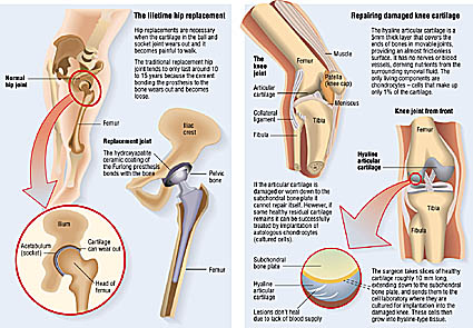 hip and knee medical illustrations