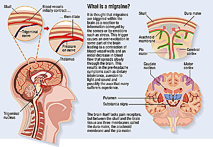 illustration of migraine artwork